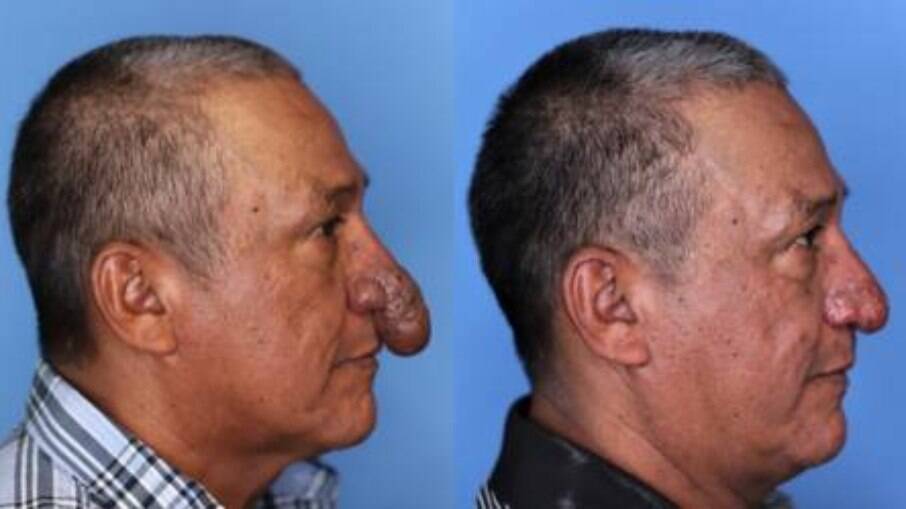Homem opera nariz que era semelhante a um pênis, nos EUA