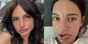 Influencer tem lábio desfigurado ao 'mastigá-lo' durante o sono