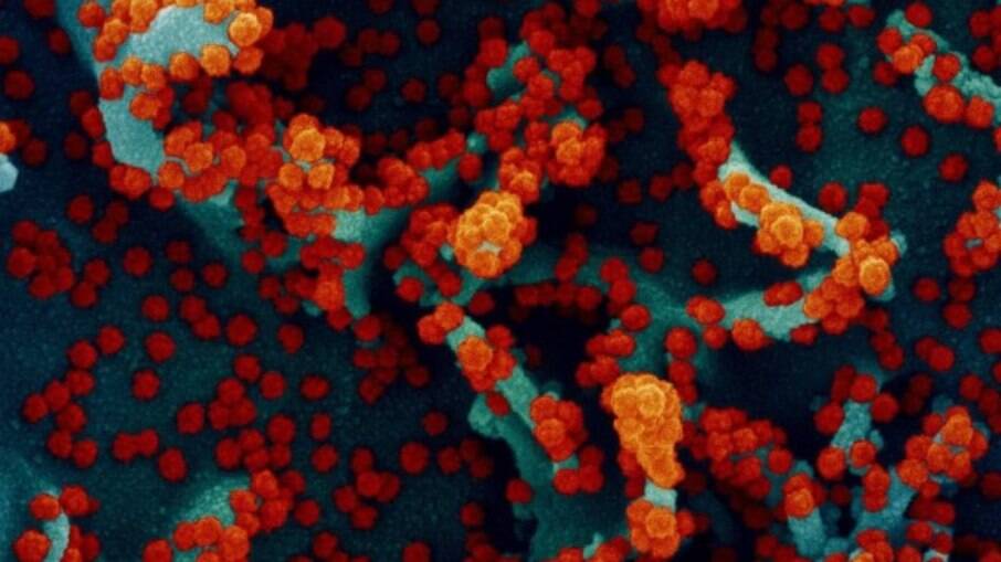 Micrografia eletrônica de varredura colorida mostra célula fortemente atacada pelo SARS-Cov-2 (em vermelho) 