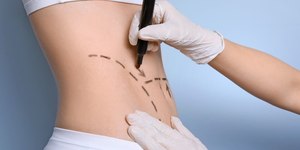 Cinco verdades que todos precisam saber antes de realizar uma lipo