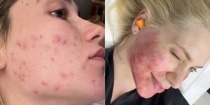 Virginia surge com o rosto vermelho após procedimento: "Queima"