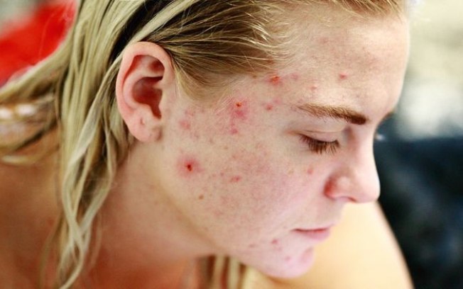 Bactérias da pele são usadas em novo tratamento contra acne