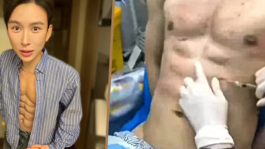 Homem gasta U$ 560 mil em injeções de ácido hialurônico para esculpir abdômen