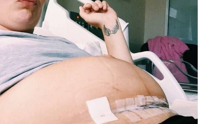 Mãe compartilhou foto de cesárea horas após o procedimento para mostrar que não há forma mais fácil de se ter um filho