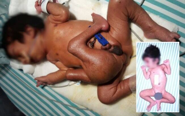 Após a cirurgia, médicos afirmaram que não há mais sinais do gêmeo parasita no menino – confira na foto menor à direita