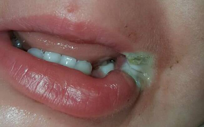 Machucado feio na boca da menina foi causado por um carregador de celular durante um momento de distração