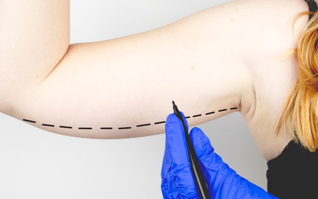 Lipoaspiração é a cirurgia plástica mais comum no Brasil, segundo pesquisa