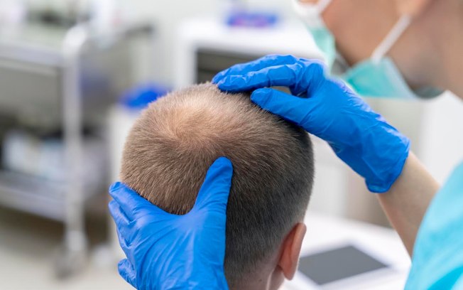 Medicina capilar avança e amplia possibilidade de tratamento