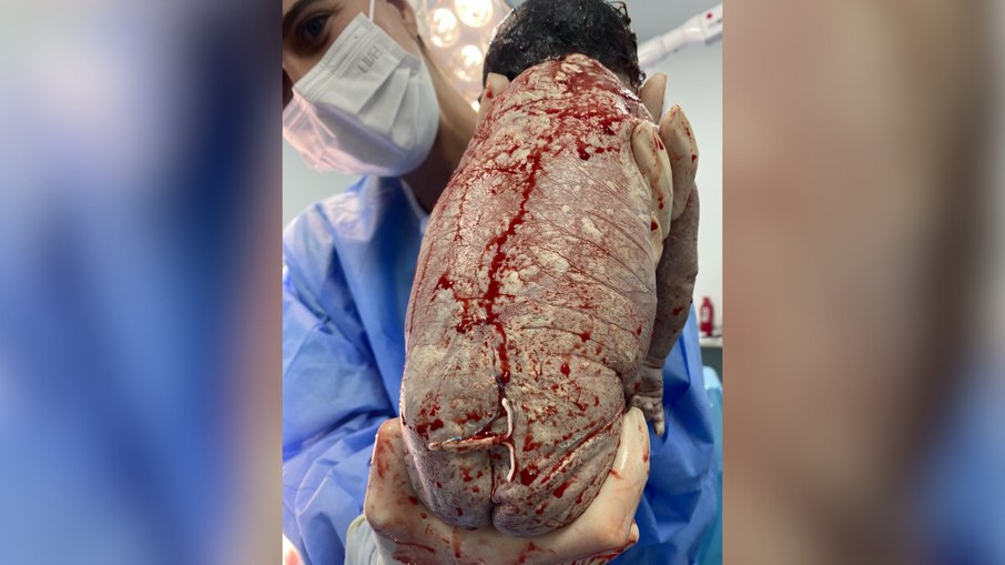 Bebê nasce com DIU preso ao corpo e imagem viraliza na web Bebê nasce com DIU preso ao corpo e imagem viraliza na web