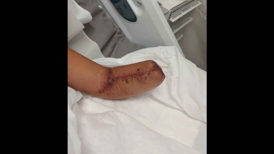 Gleice teve o braço amputado após complicações relacionadas a parto