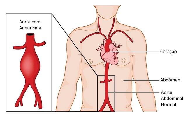 Aneurisma de aorta abdominal: saiba como a doença afeta a saúde - principalmente dos homens - e como preveni-la Aneurisma de aorta abdominal: saiba como a doença afeta a saúde - principalmente dos homens - e como preveni-la