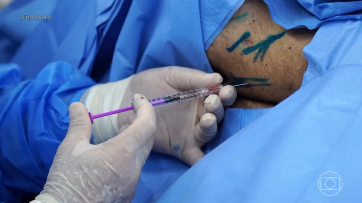 Avanço da polilaminina mira caminho inédito contra a paraplegia