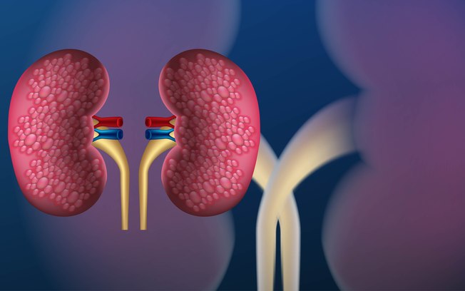 Doença renal crônica subdiagnosticada causa mortes
