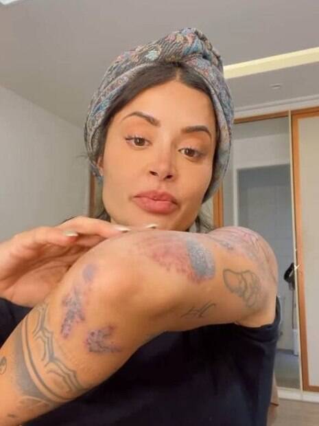Aline Campos mostra processo de remoção de tatuagens