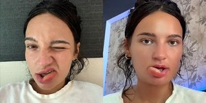 Influencer tem lábio desfigurado ao 'mastigá-lo' durante o sono