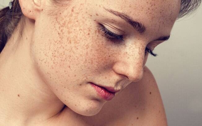 As sardas no rosto são bem diferentes de doenças de pele, como melasma, mas merecem atenção e visitas à profissionais
