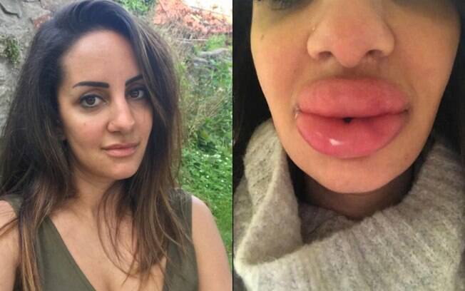 Sarah Najjar sonhava em fazer preenchimento labial, mas um erro no procedimento deixou sua boca inchada e dura