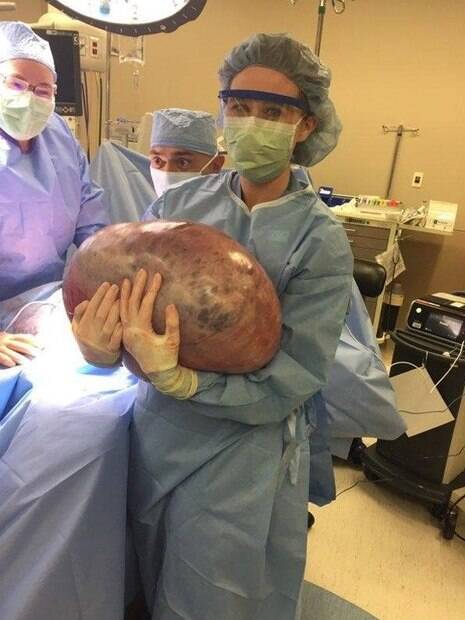 Cisto no ovário de Rahn chegou a pesar 22,6 quilos, de acordo com os especialistas do Jackson Hospital