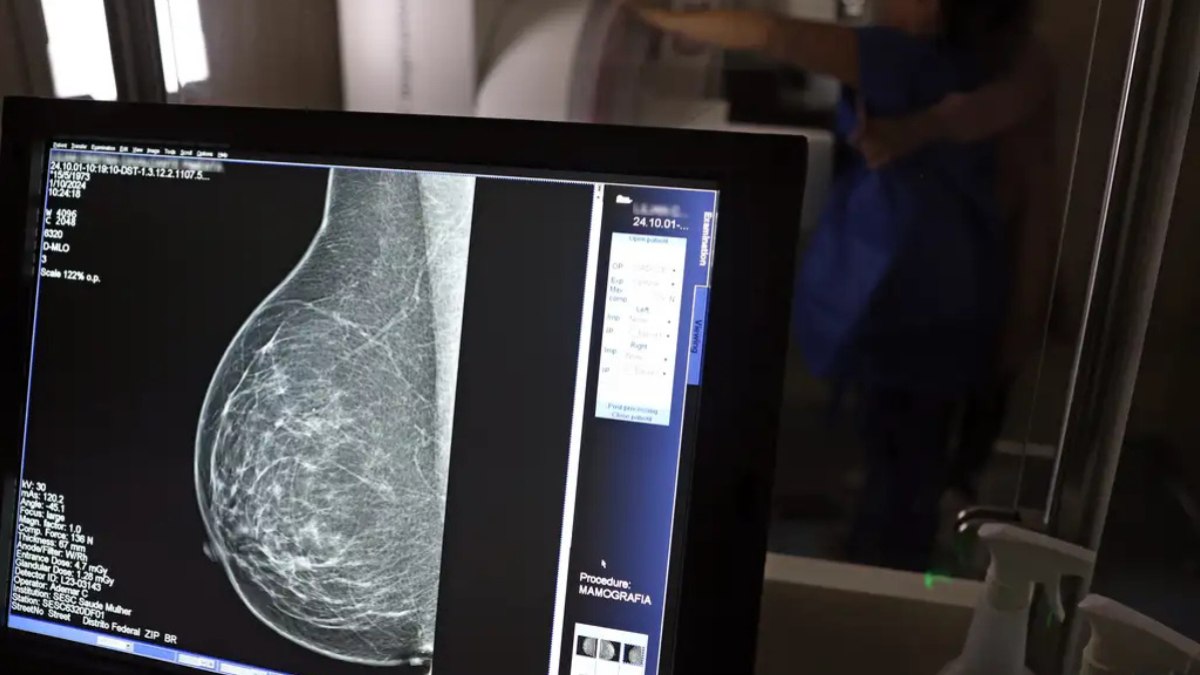 Anteriormente, o SUS recomendava a mamografia para mulheres de 50 a 69 anos Anteriormente, o SUS recomendava a mamografia para mulheres de 50 a 69 anos