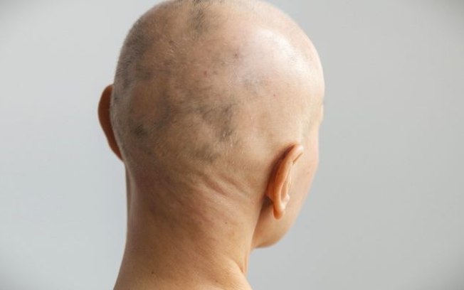 Alopecia areata | Anvisa aprova remédio para casos graves de perda de cabelo