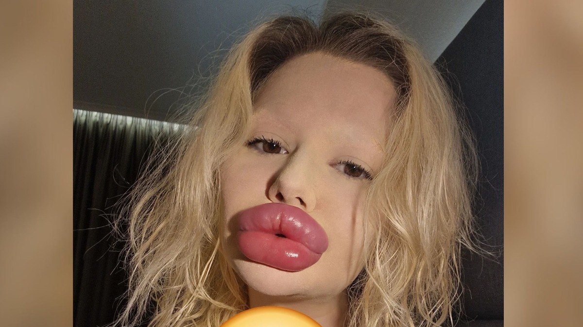 Mulher%20com%20l%C3%A1bios%20gigantes%20chama%20aten%C3%A7%C3%A3o%20da%20web