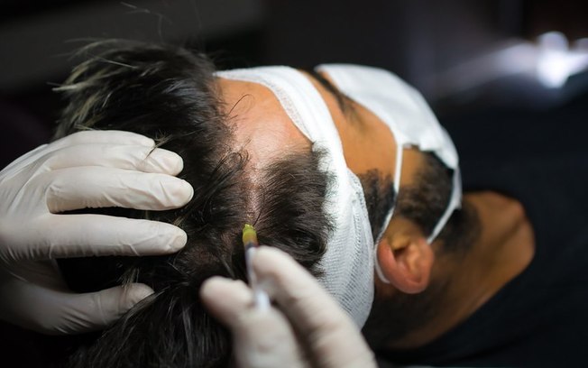 As opções de tratamento para quem teve queda de cabelo pós-covid