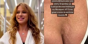 Dany Bananinha expõe cicatriz no seio após cirurgia de emergência