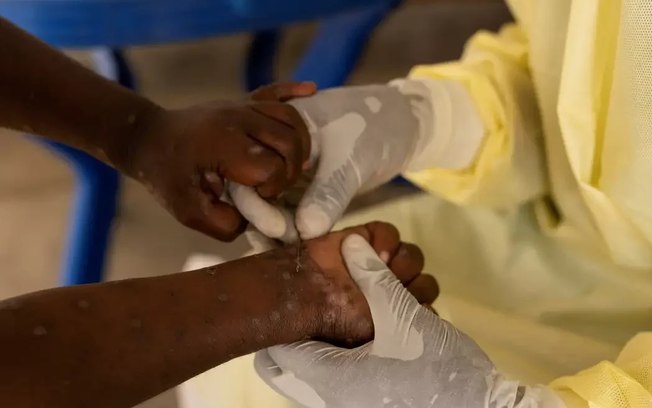 África declara emergência em saúde pública por epidemia de mpox