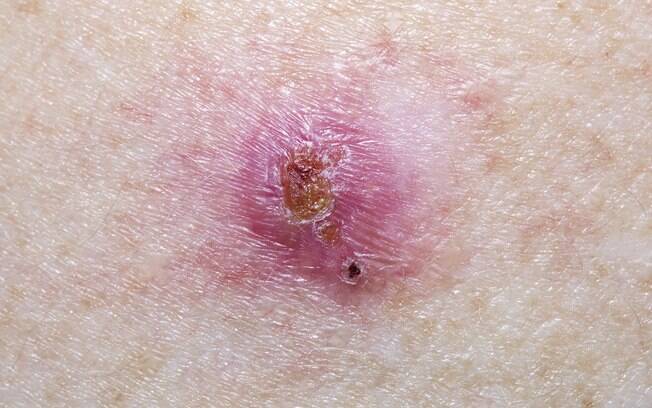O carcinoma basocelular pode ser caracterizado como um caroço na pele que pode ser rosa ou branco com manchas escuras O carcinoma basocelular pode ser caracterizado como um caroço na pele que pode ser rosa ou branco com manchas escuras