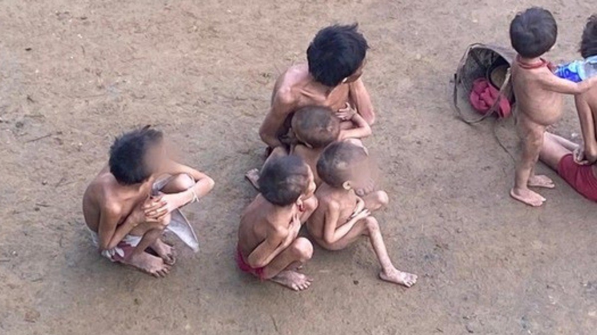 Crianças Yanomamis desnutridas