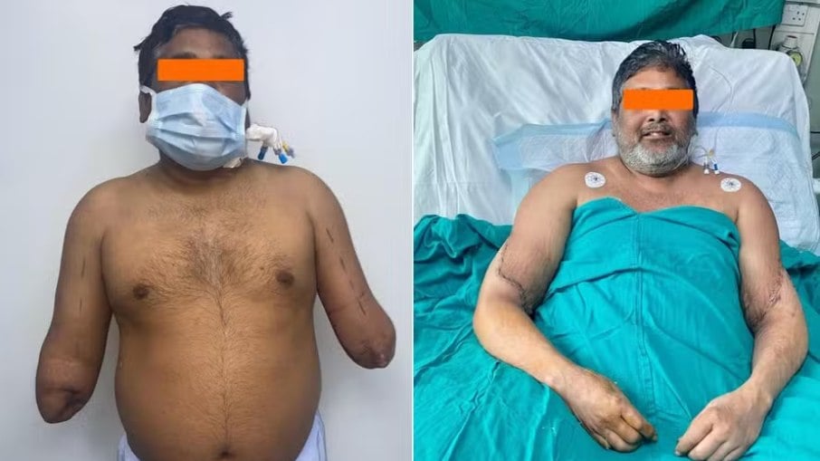 Pintor indiano recuperou as duas mãos em primeiro transplante bilateral na Índia