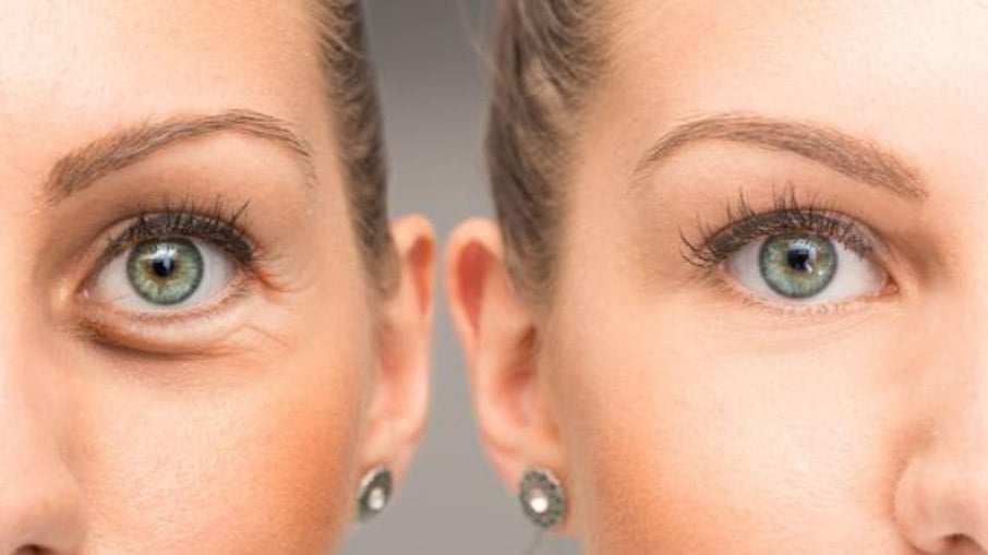 Fillers can make bags under the eyes worse.