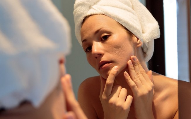 5 principais tipos de acne e como tratá-las
