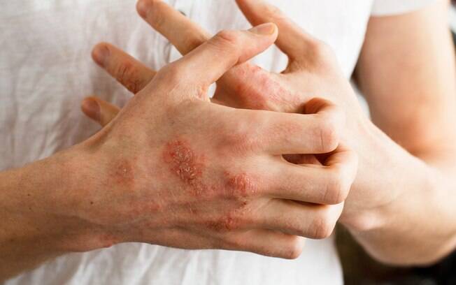 Eczema: estudo feito no Reino Unido estima que 15 milhões de britânicos sofre com a condição