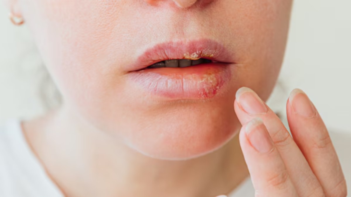 O tratamento do herpes labial envolve o uso de medicamentos antivirais