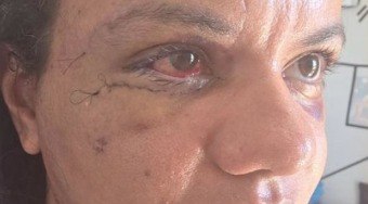Mulher%20espancada%20com%2061%20socos%20revela%20o%20p%C3%B3s-cirurgia