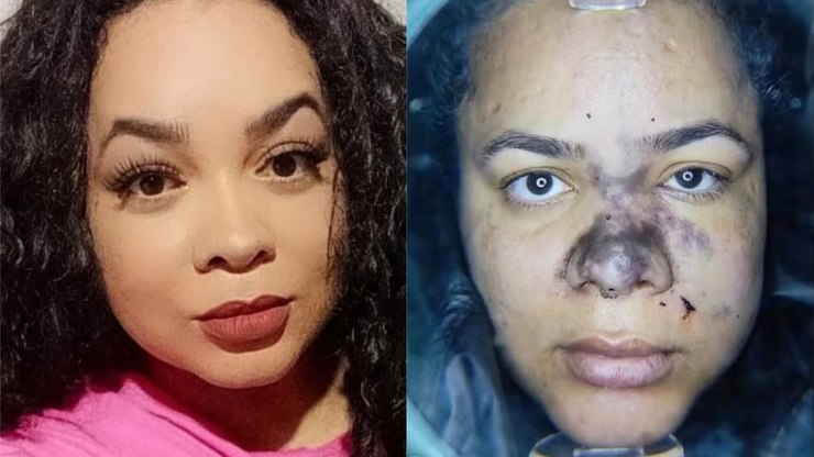 Influenciadora sofre necrose facial após uso de PMMA: "Em choque"