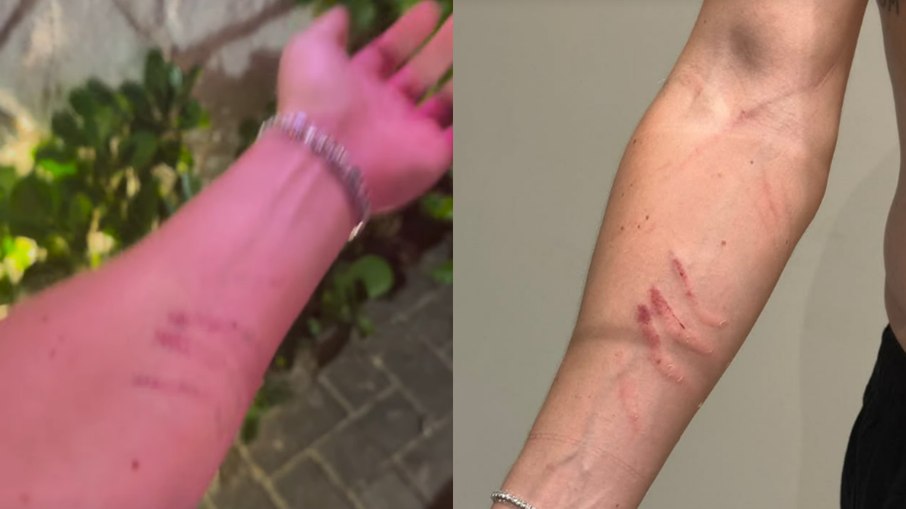 Danilo Bravo exibe hematomas no braço