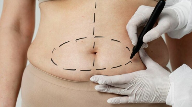 O que considerar antes de fazer cirurgia plástica na menopausa