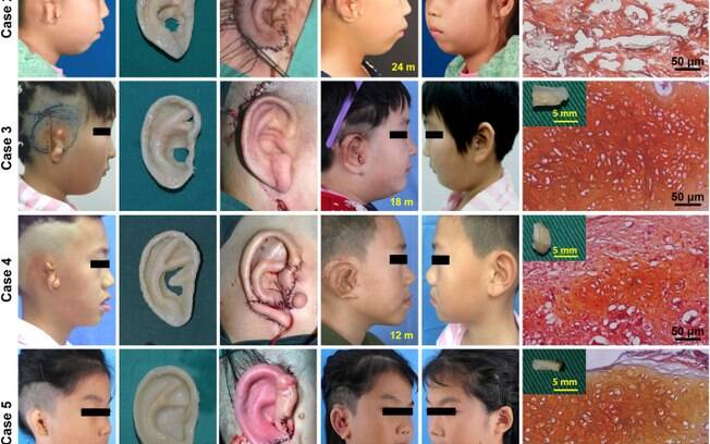 A reconstrução das orelhas foi realizada em pacientes que apresentavam quadro de uma deformidade congênita