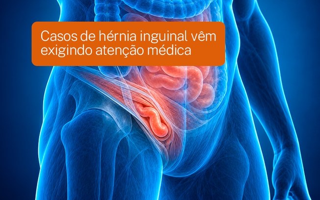 Casos de hérnia inguinal vêm exigindo atenção médica