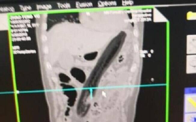 Homem foi socorrido em um hospital da China após ficar com uma berinjela presa em seu intestino na última semana Homem foi socorrido em um hospital da China após ficar com uma berinjela presa em seu intestino na última semana