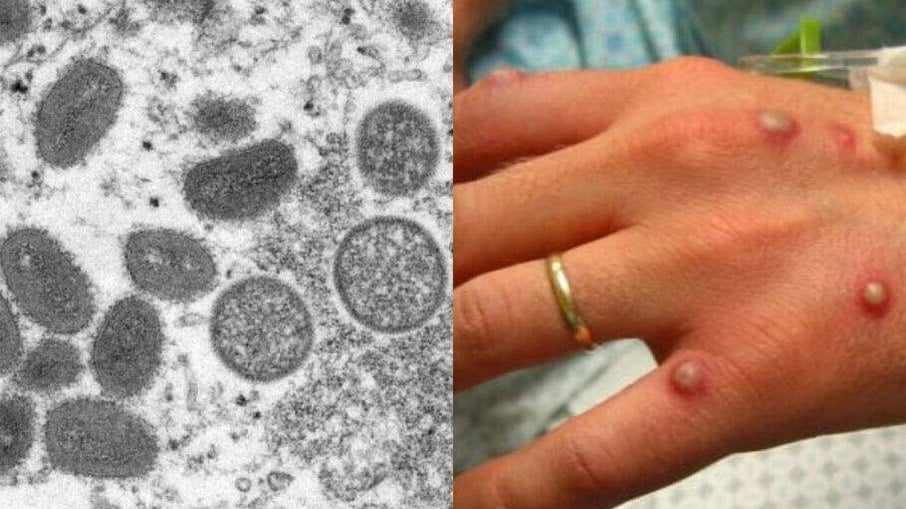 Vírus da varíola dos macacos e um dos sintomas que a doença pode causar na pessoa infectada