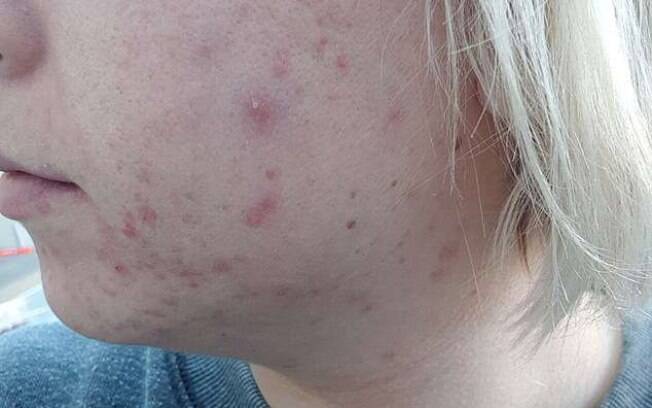 Apesar de algumas cicatrizes causadas pela acne severa, em três meses de tratamento já foi possível ver a diferença Apesar de algumas cicatrizes causadas pela acne severa, em três meses de tratamento já foi possível ver a diferença
