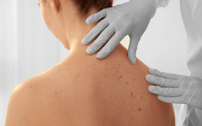 Anualmente, 180 mil brasileiros recebem o diagnóstico de câncer de pele, sendo 4% melanoma Anualmente, 180 mil brasileiros recebem o diagnóstico de câncer de pele, sendo 4% melanoma