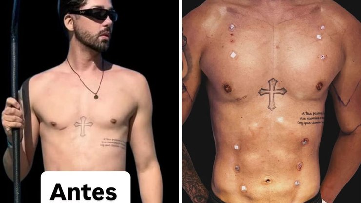 Rico Melquiades Defende Novas Cirurgias Estéticas: 'Vou Fazer'