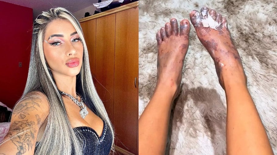 Modelo brasileira sofreu queimaduras nos pés