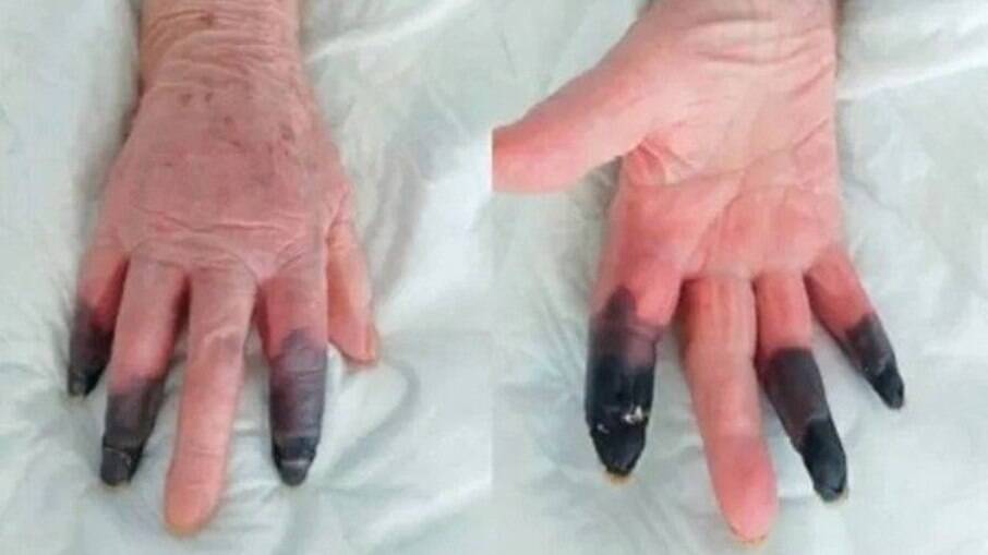 Idosa de 86 anos tem reação rara e teve que amputar três dedos