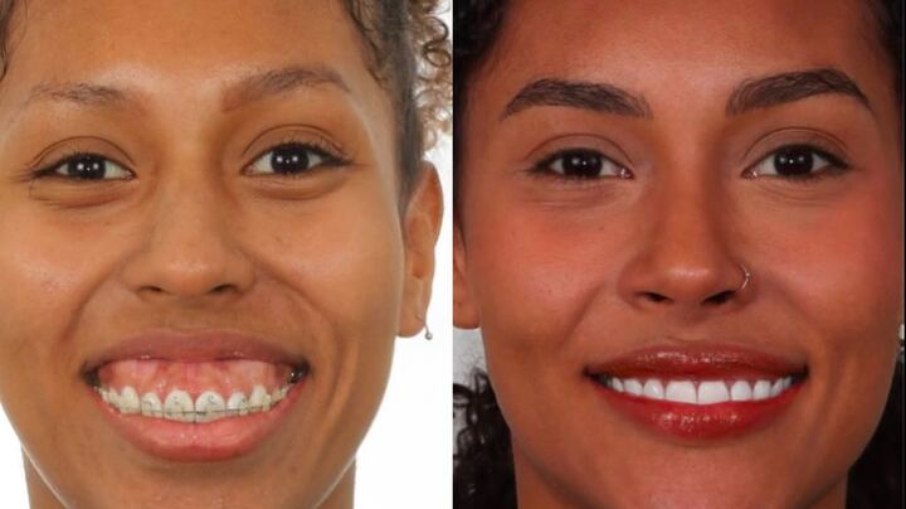 Antes e depois do sorriso de Giovanna