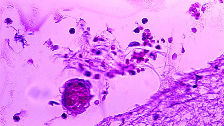 Primeiros meses de 2026 têm cerca de 2 mil casos de meningite